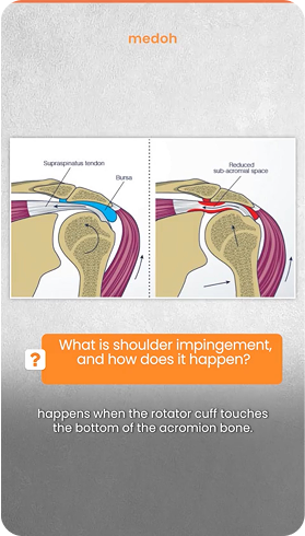 Tennis Elbow